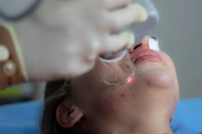 Laser Treatments Acne Scars