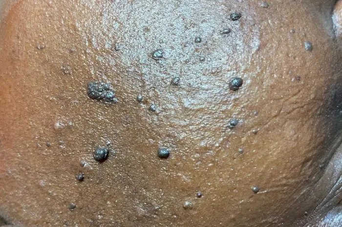 Why Remove Skin Tags